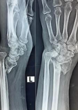 Fracture and trauma care